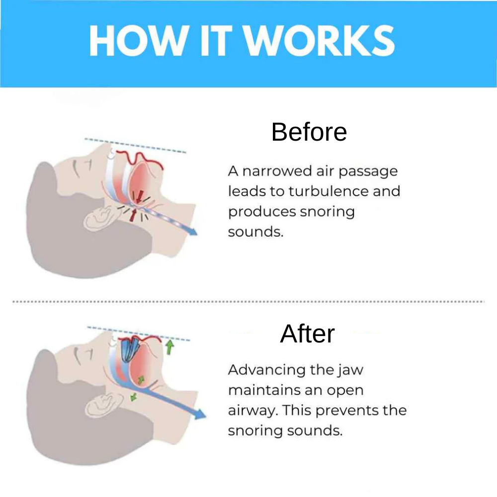 Feliora Anti-Snoring Mouthpiece