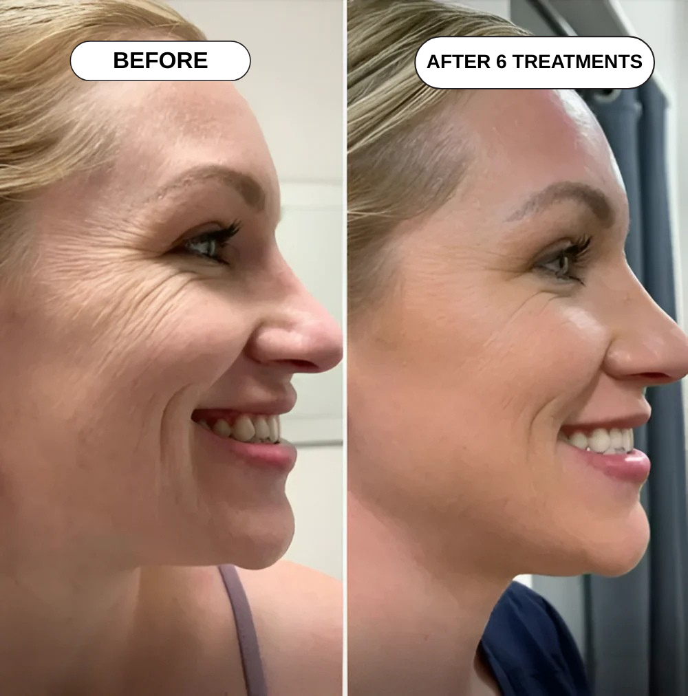 Feliora Micro Infusion System