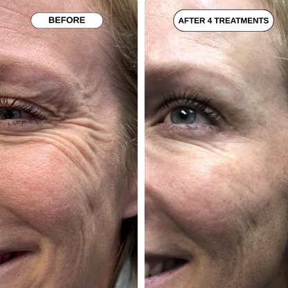 Feliora Micro Infusion System