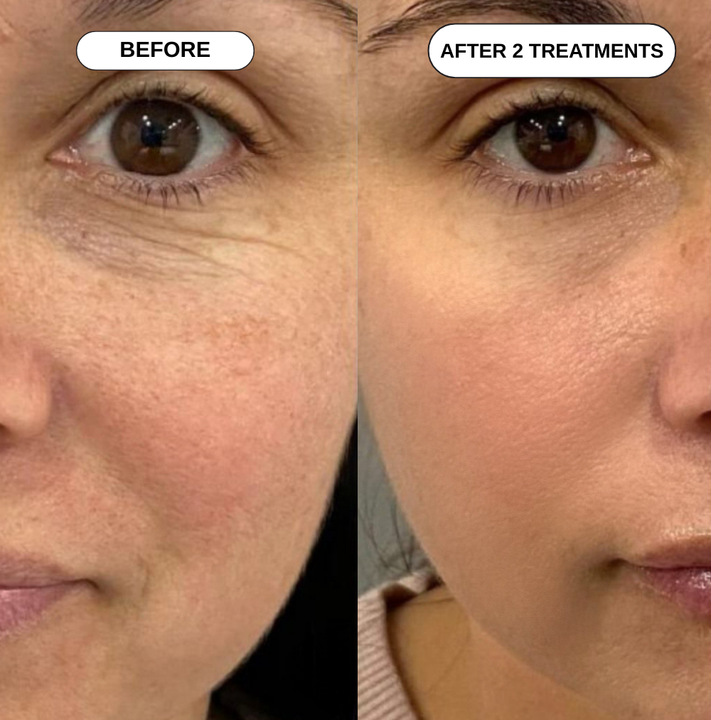 Feliora Micro Infusion System