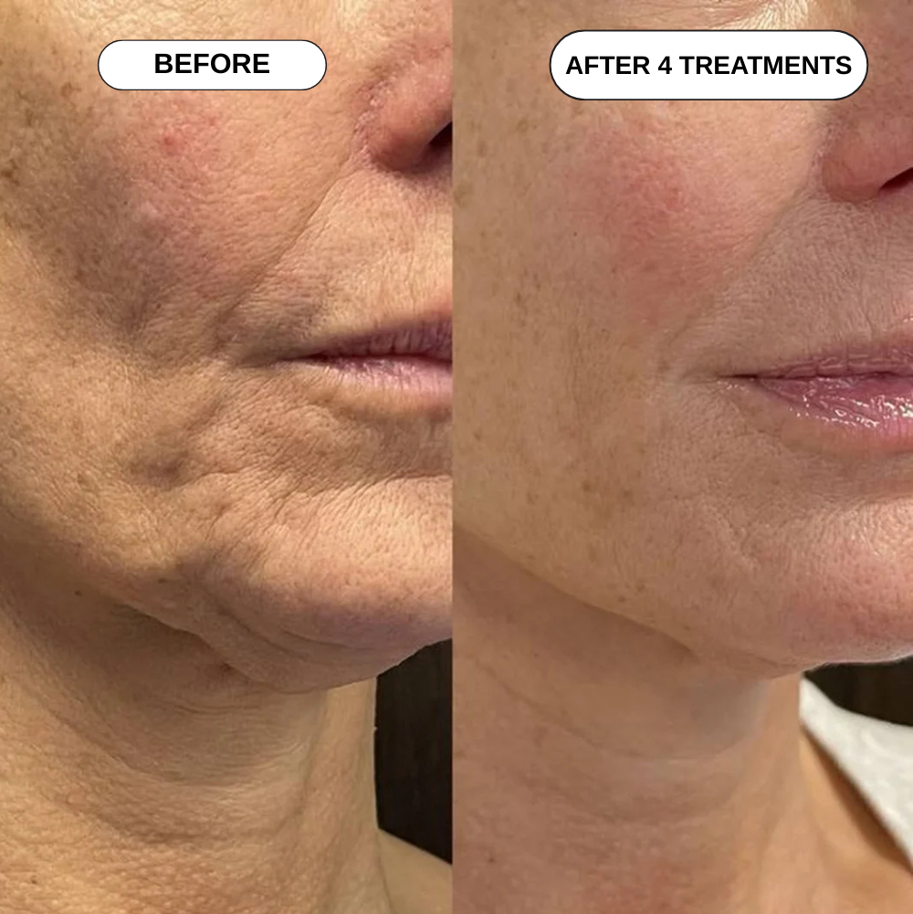 Feliora Micro Infusion System