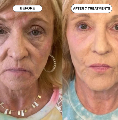 Feliora Micro Infusion System