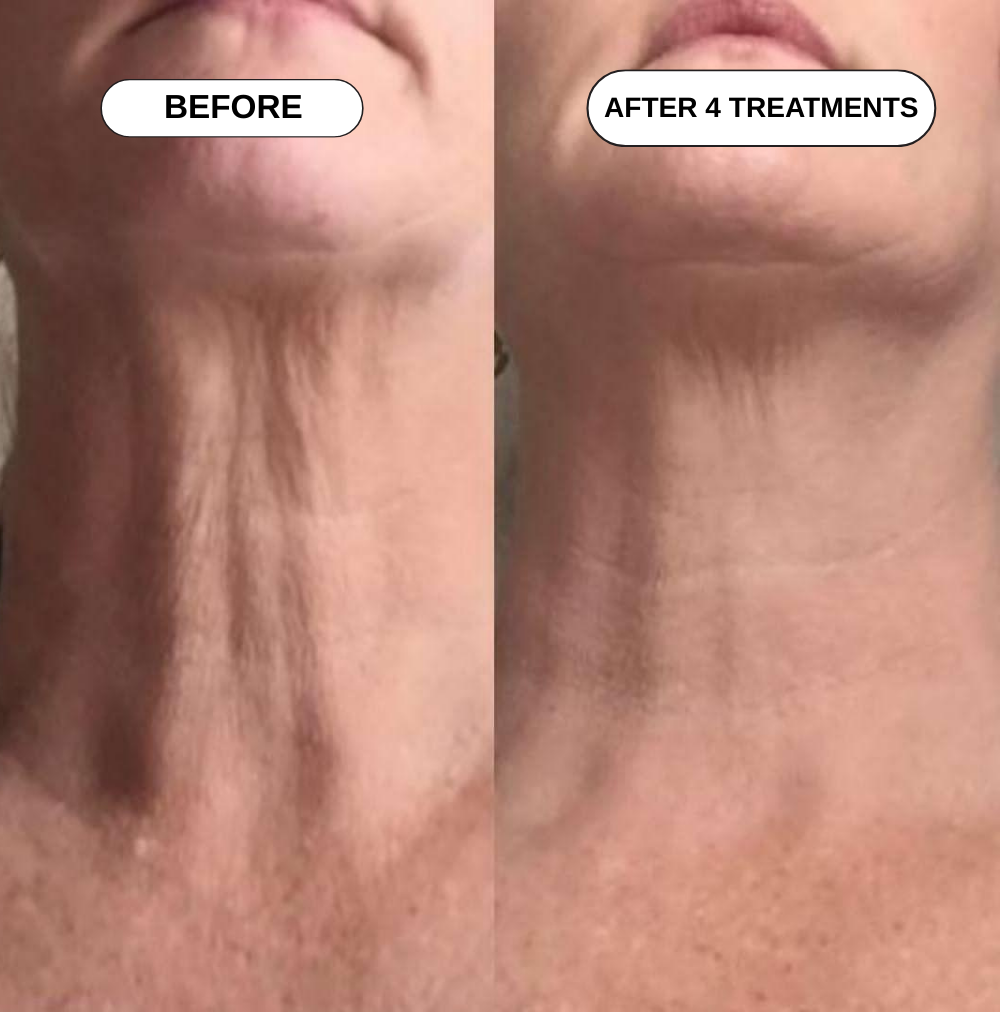 Feliora Micro Infusion System