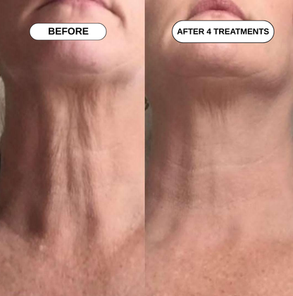 Feliora Micro Infusion System