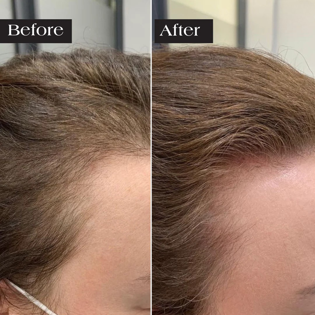 Feliora Hair Regrowth System
