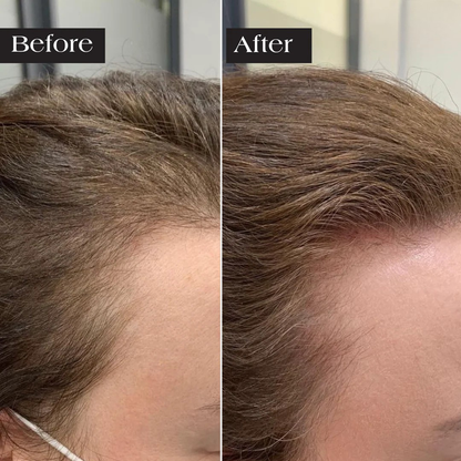 Feliora Hair Regrowth System