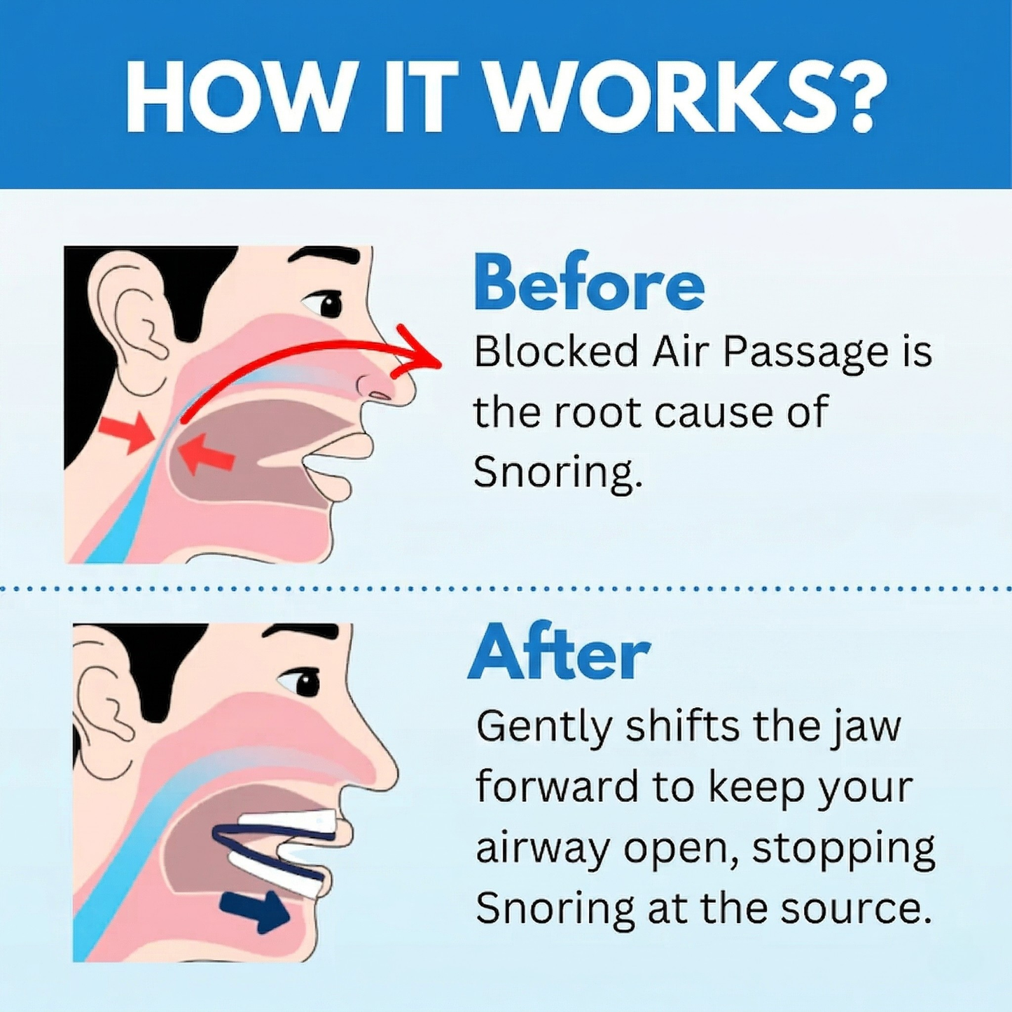 Feliora Anti-Snoring Mouthpiece