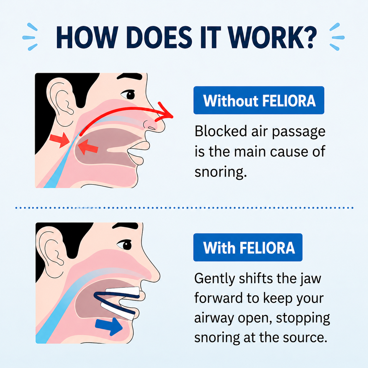 Feliora Anti Snoring Mouthpiece